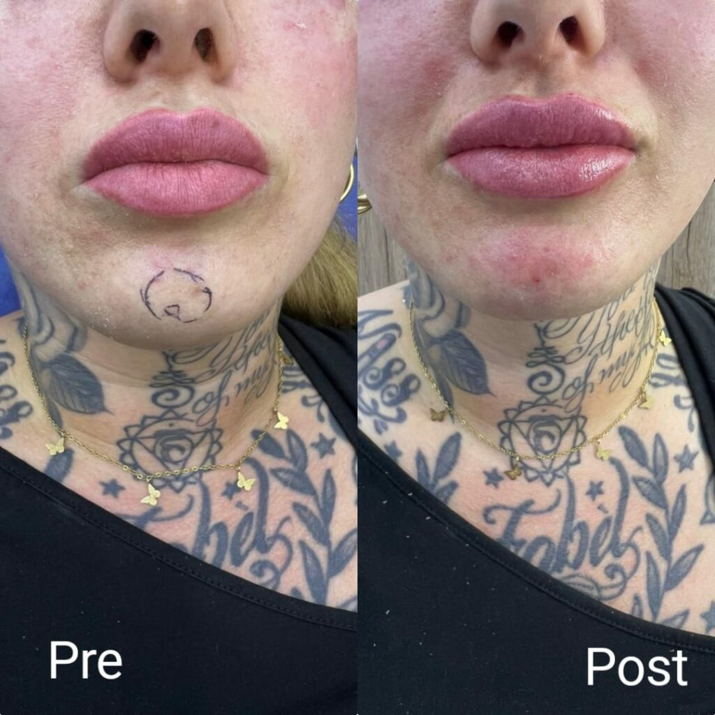 Lips flip in Nadara Clinic